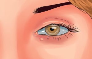 як відрізнити халязіон